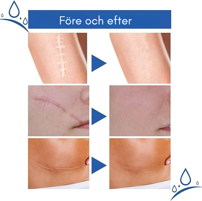 Scar Removal Cream - minskar Àrr och hudbristningar