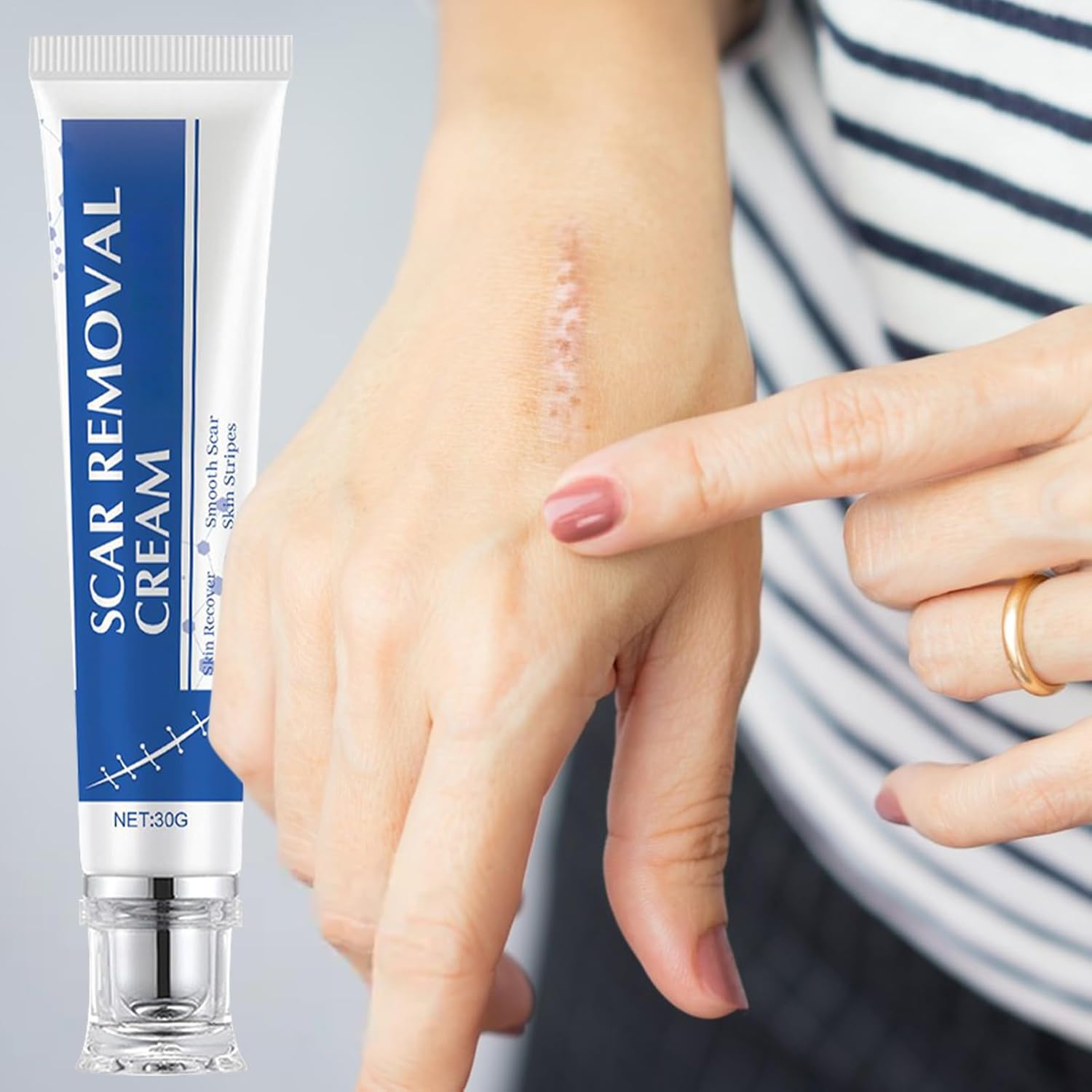 Scar Removal Cream - minskar ärr och hudbristningar